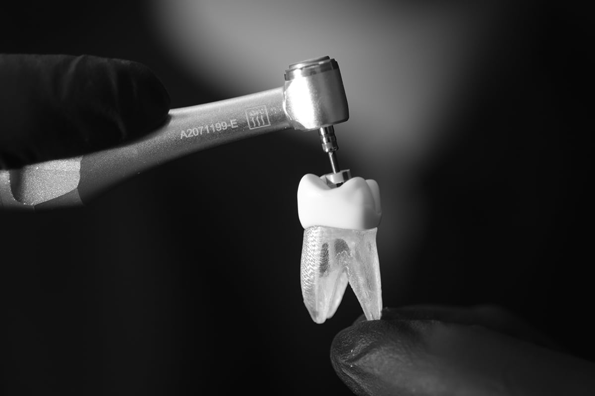 Signs you might need a root canal recognize the symptoms 2 blog